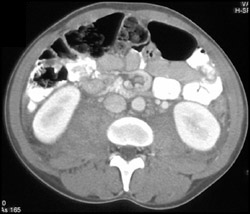 Bilateral Psoas Bleeds - CTisus CT Scan