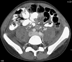 Psoas Abscess - CTisus CT Scan