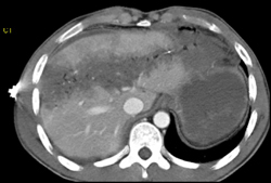 Liver Laceration S/P GSW - CTisus CT Scan