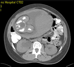 Pregnant Patient S/P MVA - CTisus CT Scan