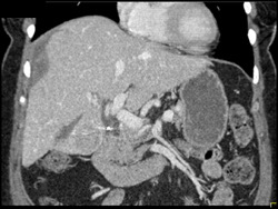 Liver Laceration - CTisus CT Scan