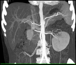 Renal Laceration - CTisus CT Scan