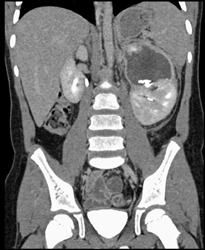 Renal Laceration - CTisus CT Scan