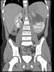 Renal Laceration - CTisus CT Scan