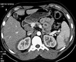 Splenic Laceration - CTisus CT Scan