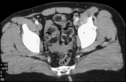 Blood in Pelvis - CTisus CT Scan