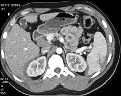 Splenic Laceration and Subhepatic Blood - CTisus CT Scan