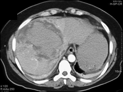 Intrahepatic Bleed - CTisus CT Scan