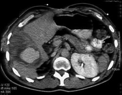 Active Intrahepatic Bleed - CTisus CT Scan