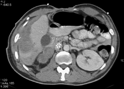 Hepatic Subcapsular Bleed - CTisus CT Scan