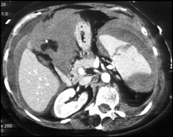 Intra-abdominal Bleed With Splenic Laceration - CTisus CT Scan