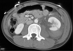 Renal Laceration - CTisus CT Scan