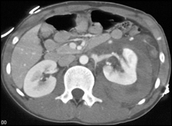 Renal Laceration - CTisus CT Scan