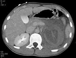 Renal Laceration - CTisus CT Scan