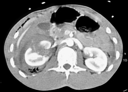 Renal Laceration With Active Bleed - CTisus CT Scan