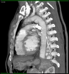 Traumatic Aortic Dissection in Arch - CTisus CT Scan