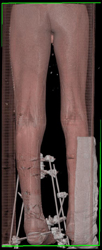 CTA Following Compound Fracture - CTisus CT Scan