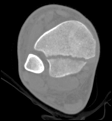 Tibial Fracture - CTisus CT Scan