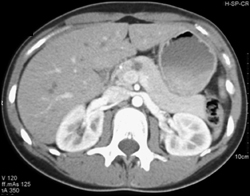 Pancreatic Injury - CTisus CT Scan