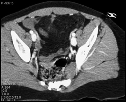 Pelvic Bleed With Tear of Omentum - CTisus CT Scan