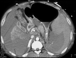 Perisplenic Bleed - CTisus CT Scan