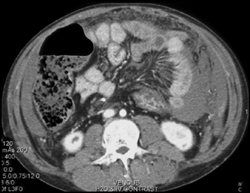 Mesenteric Bleed - CTisus CT Scan