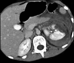 Renal Laceration - CTisus CT Scan