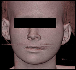 Orbital Fracture - CTisus CT Scan