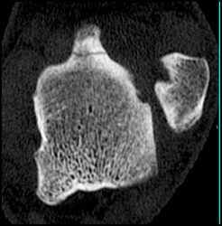 Talus Fracture - CTisus CT Scan