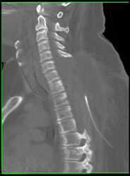 Hematoma S/P C-spine Resection - CTisus CT Scan