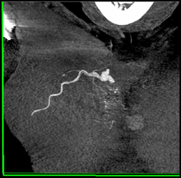 Active Bleed in Chest Wall - CTisus CT Scan