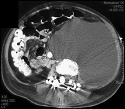 Retroperitoneal Hematoma - CTisus CT Scan