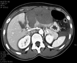 Liver Laceration With Bleed S/P Biopsy - CTisus CT Scan