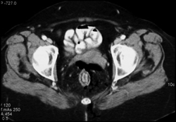 Perforated Rectum - CTisus CT Scan