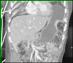 Ruptured Diaphragm With Stomach Herniation - CTisus CT Scan