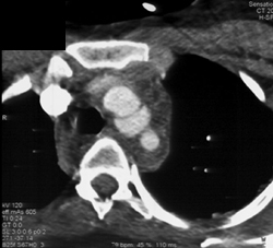 Aortic Injury - CTisus CT Scan