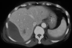 Subcapsular Bleed S/P Biopsy of A Hemangioma - CTisus CT Scan