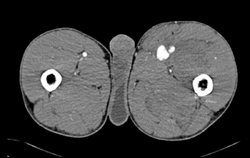 Pseudoaneurysm S/P Trauma Off SFA - CTisus CT Scan