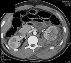 Renal Laceration - CTisus CT Scan