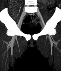 Occluded Left External Iliac Artery S/P Fall Off Bike - CTisus CT Scan