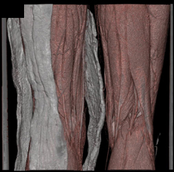 Patent SFA and Popliteal Artery S/P Trauma - CTisus CT Scan