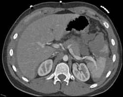 Splenic Laceration - CTisus CT Scan