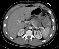 Splenic Laceration - CTisus CT Scan