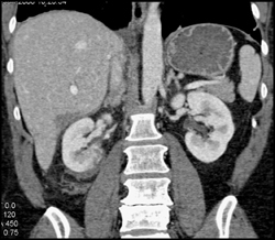 Renal Laceration - CTisus CT Scan