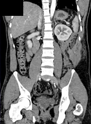 Renal Laceration - CTisus CT Scan