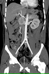 Renal Laceration - CTisus CT Scan