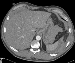 Splenic Laceration - CTisus CT Scan