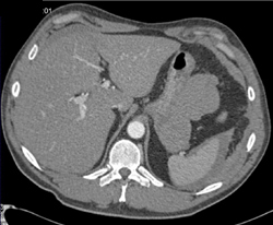 Splenic Laceration - CTisus CT Scan