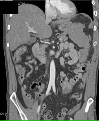 Splenic Laceration - CTisus CT Scan