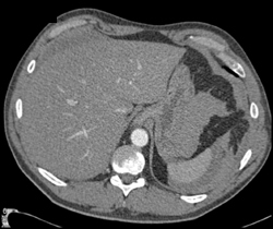 Splenic Laceration - CTisus CT Scan